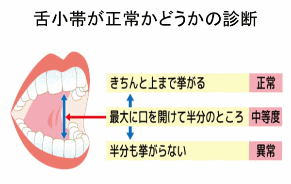 舌小帯が正常かどうかの診断