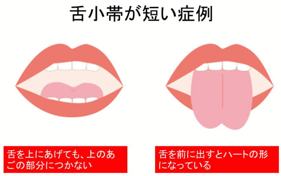 舌小帯が短い症例