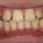 歯の萌出位置異常